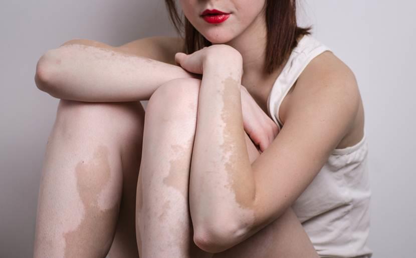 All You Need to Know About Vitiligo! 